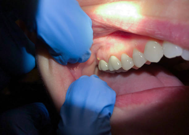 Best Lost Filling or Crown Replacement in Hemby Bridge, NC